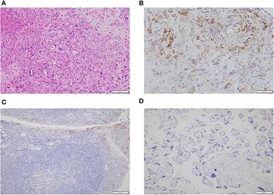 Durable Response and Good Tolerance to the Triple Combination of Toripalimab, Gemcitabine, and Nab-Paclitaxel in a Patient With Metastatic Pancreatic Ductal Adenocarcinoma